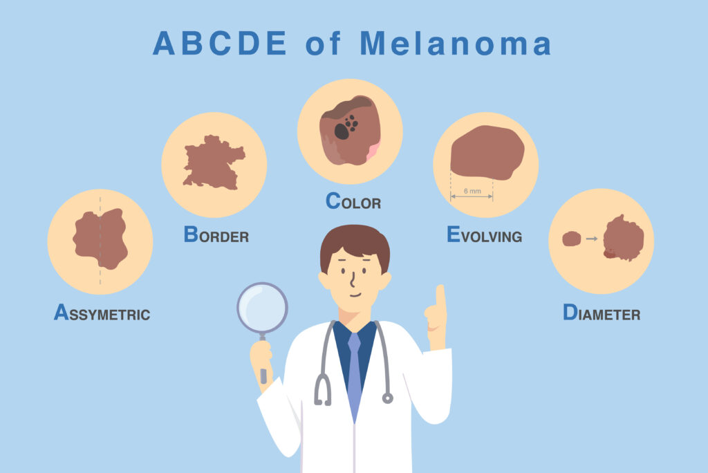 Doctor holding magnifies glass with 5 characteristics of skin damage from cancer cell Illustration about diagnosis and classification of melanoma by use ABCDE letter