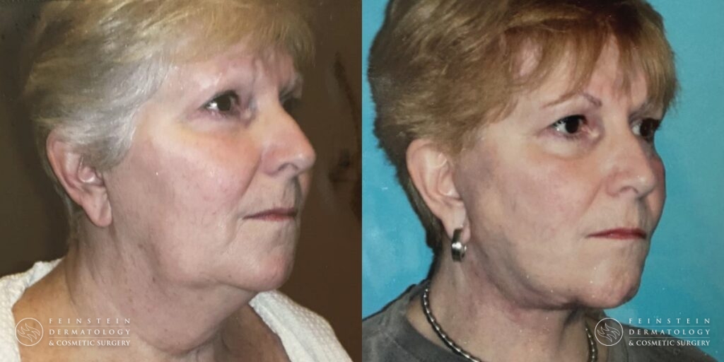 Feinstein BA Facelift Browlift Upper Bleph Lipo Patient 1a